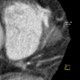 Myocardial bridging of LAD, left anterior descending artery: CT - Computed tomography